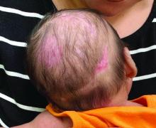 Semicircular patches of alopecia with some areas of pink rubbery plaques with loss of hair follicles