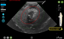 The SMART Guide delineates the ablation zone and thermal safety border. Everything within the ablation zone will be thermally ablated