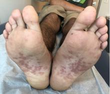 There are many dark pink papules and plaques with overlying scale on the soles of the feet of the 17-year-old male.