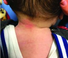This 7-month-old male presents with a worsening posterior neck rash with pink papules.