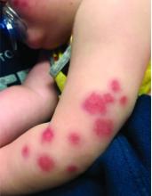 There are purpuric papules and nodules on child's right arm. there is some edema.