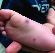 There are purpuric papules on child's foot.