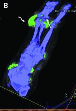 Gout tophus formation (curved arrow) shown on 80-kV DECT with color-coded overlay showing monosodium urate crystals in green and calcium in blue, as well as articular and juxta-articular osseous erosions (straight arrow).