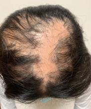 A young adolescent girl with 50% loss of hair on the superior scalp with preservation of the anterior hair line.