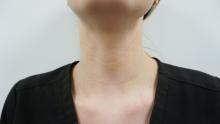 Horizontal neck lines in a 23-year-old woman