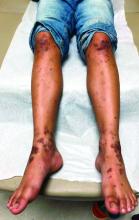 Lichenified papule and plaques on the legs