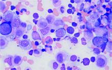 A bone marrow aspirate specimen shows characteristic vacuoles present in myeloid precursor cells of VEXAS patients.