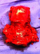 Radical hysterectomy specimen