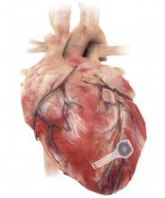 An illustration of the leadless, battery-free pacemaker mounted on the heart.