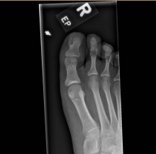An x-ray of a foot
