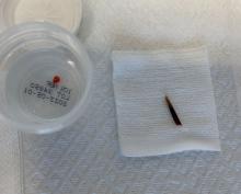 Wood splinter extracted from patient.