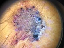 On dermatoscopy the lesion showed multiple dilated red and violaceous lacunae and whitish-blue hue.