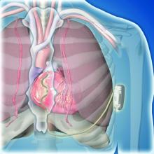 Extravascular ICD placement