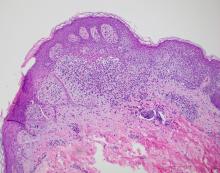 Histopathology demonstrated hyperkeratosis of the stratum corneum with focal thickening of the granular cell layer, basal layer degeneration of the epidermis, and a band-like subepidermal lymphocytic infiltrate with Civatte bodies.