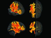 A 3-D reconstruction shows how high systolic BP has affected the main tracts of white matter in the brain. The red shows the areas most affected by high BP while the yellow areas are also affected but to a lesser extent.