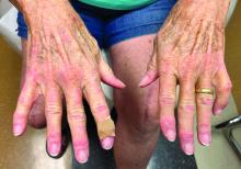 Dermatomyositis in a 75-year-old woman