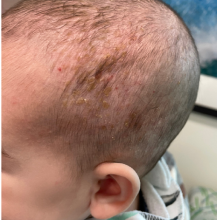 Telangiectasias on the temporal area of baby's head