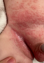 Scaly pink papules on torso and diaper area