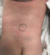 3-mm yellow papule on baby's back