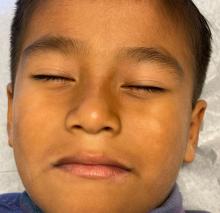 A 6-year-old presents after summer with white spots on his face.