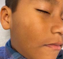 A 6-year-old presents after summer with white spots on his face.