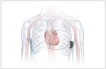 The Aurora “extravascular” implantable cardioverter-defibrillator (EV-ICD) system