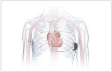 The Aurora &ldquo;extravascular&rdquo; implantable cardioverter-defibrillator (EV-ICD) system