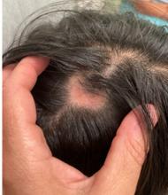 Patch of alopecia with some associated erythema and scale