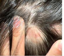 Patch of alopecia with some associated erythema and scale