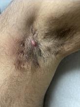 An example of early stage hidradenitis suppurativa (HS) in a patient.