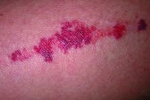 Actinic senile purpura, a common feature of dermatoporosis