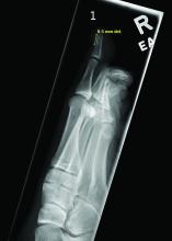 Toe xray