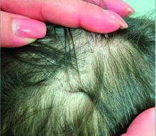 Patches of alopecia with associated scale and brown papules