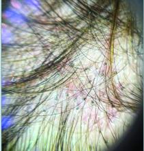 Tichoscopy showing corkscrew hairs and black dots