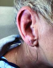 Posttreatment ear