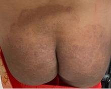 Lesion on the buttocks of patient A, one of the first two reported US cases of tinea caused by Trichophyton indotineae.