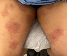 Lesions occurring on the legs in patient B, one of the first 2 reported U.S.cases of tinea caused by Trichophyton indotineae, New York City, December 2021–March 2023