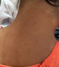 Lesion on the neck of patient A, one of the first two reported US cases of tinea caused by Trichophyton indotineae.