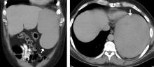 Figure 1. Coronal (left) and transverse (right) views on initial computed tomography of the abdomen without contrast showed massive splenomegaly (white arrow).