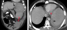 Figure 2. On repeat computed tomography with contrast, coronal (left) and transverse (right) views showed irregular splenic margins (red arrows), intraparenchymal hemorrhages (black arrows), and hemoperitoneum (white arrows).