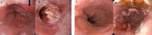 A: Endoscopic picture of Barrett esophagus with arrow pointing to nodule. B: After endoscopic mucosal resection of nodule. C: Barrett esophagus before radio­frequency ablation. D: Barrett esophagus after ablation.