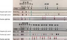 Positive Western blot test (Borrelia B31 ViraStripe [Viramed Diagnostics]) in a patient who presented with rash and arthritis. This test uses purified specific antigens of strain B31 of Borrelia burgdorferi sensu stricto. 