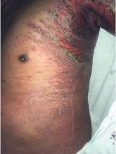 Figure 1. Desquamating rash over the left axilla.