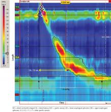 Figure 2. High-resolution esophageal manometry in our patient shows normal esophageal resting pressure and relaxation, and a distal latency of 7.5 seconds, indicating normal peristalsis.