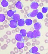 A Wright's stained bone marrow aspirate smear of patient with precursor B-cell acute lymphoblastic leukemia.