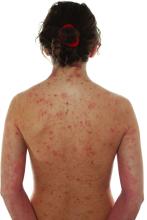 Young girl with atopic dermatitis on her back