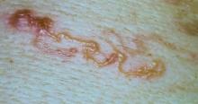 FIGURE 3. Developed serpiginous rash of cutaneous larval migrans.