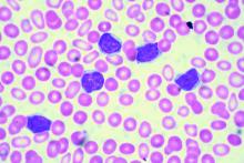 Chronic lymphocytic leukemia