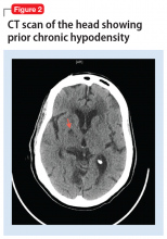 CT scan of the head showing prior chronic hypodensity