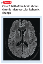 Case 2: MRI of the brain shows chronic microvascular ischemic change